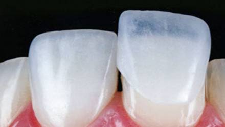 lente de contato dental